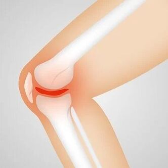 Osteoarthritis is a common non-inflammatory pathology