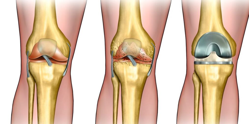 Arthritis of the knee joint