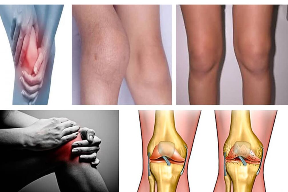 The symptoms of knee arthrosis
